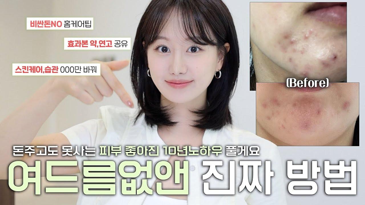 열 내리고 피지 잡는다! 10년 여드름러의 좁쌀 탈출법